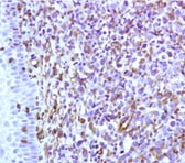 Figure 13. Immunohistochemistry on formalin fixed, paraffin embedded section of human tonsillar lymphoma.