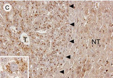 Paraffin-embedded mouse liver cancer tissue is stained with C5a Complement Antibody (Cat. No. 250565), from Yamamoto M.et al. 2017.