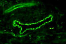 CD34 staining in human gastric adenocarcinoma. Formalin-fixed paraffin-embedded human gastric adenocarcinoma is stained with CD34 Antibody (Cat. No. 250591) used at 1:200 dilution.