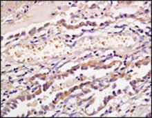 OAT-3 staining in stomach cancer tissue: Paraffin-embedded stomach cancer tissue is stained with OAT-3 Antibody (Cat. No. 250799) used at 1:200 dilution. 