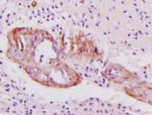 CD225 staining in human glioma. Paraformaldehyde-fixed paraffin-embedded human glioma tissue is stained with CD225 Antibody (Cat. No. 251403) used at 1:200 dilution.