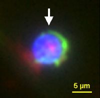 Immunofluorescence (Circulating Glioblastoma Multiforme Cell)