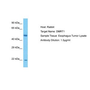 Human Esophagus Tumor