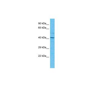 Human Thyroid Tumor