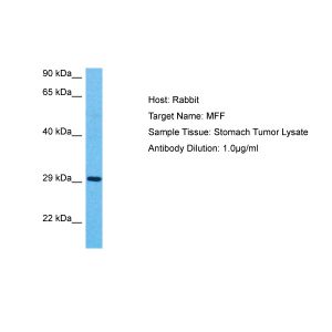 Human Stomach Tumor