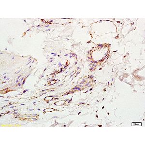 Human colon carcinoma