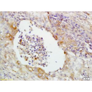 Human lung carcinoma