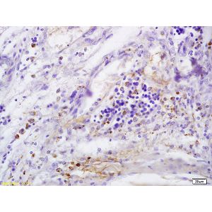 Human cervical carcinoma