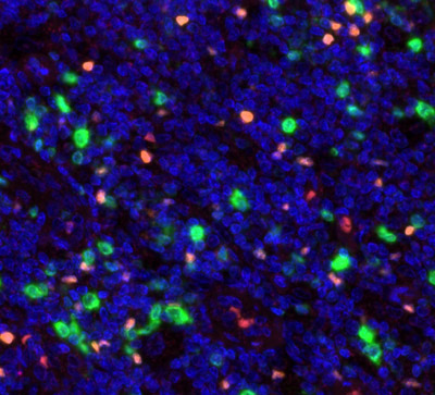 Fig.02 Immunofluorescence of FOXP3 (red) and CD112R (green), magnification 40x