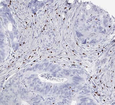 Fig.03 FOXP3-IHC in Stroma Colon Ca