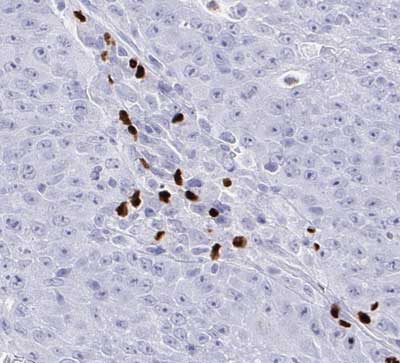 Fig.05 IHC detection of FOXP3-positive TILs in pancreatic Ca (40x)