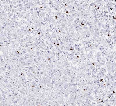 Fig.06 IHC detection of FOXP3-positive TILs in in stomach Ca (20x)