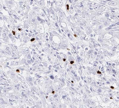 Fig.07 IHC detection of FOXP3-positive TILs in stomach Ca (40x)