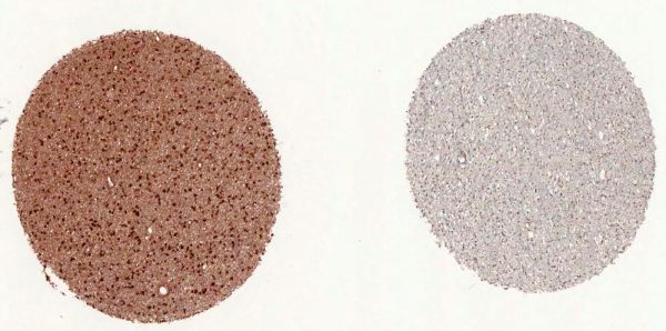 IDH1-R132H-strong-reaction-on-mutated-diffuse-astrocytoma