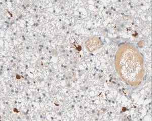 Immunohistochemical staining (IHC) with anti-IDH1 R132H Antibody (clone H09) - dianova