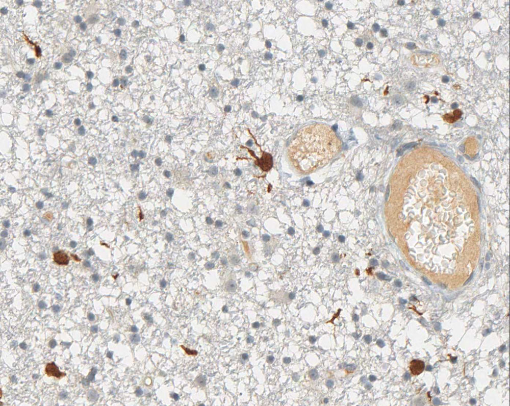 Immunohistochemical staining (IHC) with anti-IDH1 R132H Antibody (clone H09) - dianova