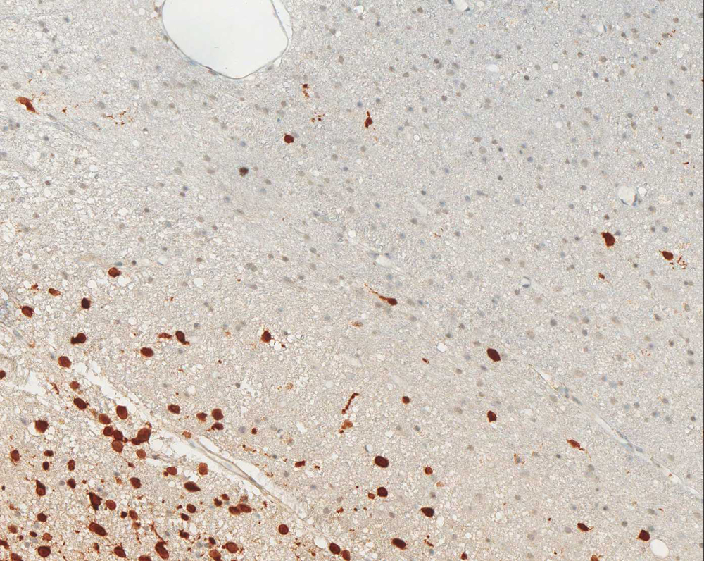 Immunohistochemical staining (IHC) with anti-IDH1 R132H Antibody (clone H09) - dianova