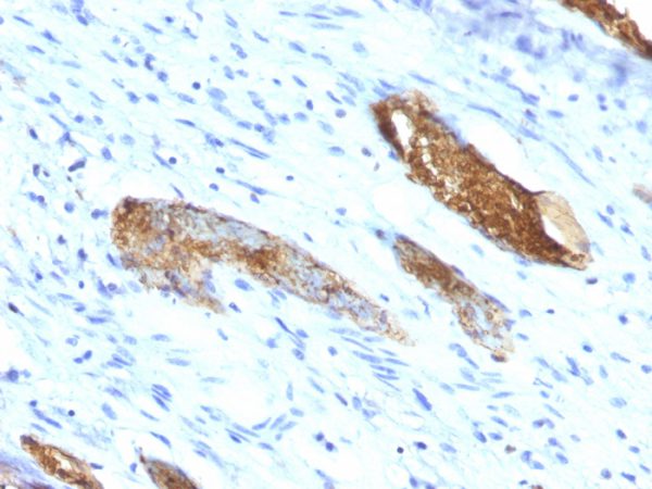 Formalin-paraffin human Colon Carcinoma stained with Blood Group Antigen A MAb (33C13)