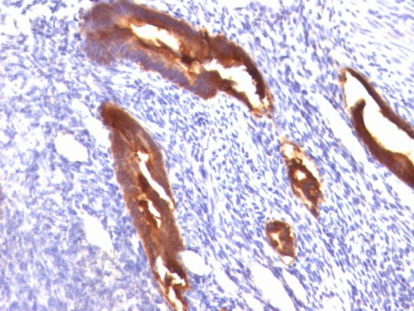 Formalin-fixed, paraffin-embedded human Endometrial Carcinoma stained with MUC-1 Mouse Monoclonal Antibody (MUC1/845).