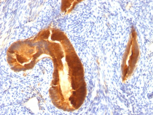 Formalin-fixed, paraffin-embedded human Endometrial Carcinoma stained with MUC-1 / CA15-3 / EMA Mouse Monoclonal Antibody (MUC1/955).