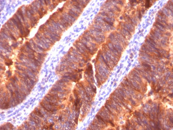 Formalin-fixed, paraffin-embedded human Colon Carcinoma stained with MUC-1 / CA15-3 / EMA Mouse Monoclonal Antibody (MUC1/520).