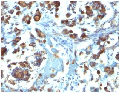 Formalin-fixed, paraffin-embedded human gastric carcinoma stained with MUC3 Mouse Monoclonal Antibody (M3.1). HIER: Tris/EDTA, pH9.0, 45min. 2°C: HRP-polymer, 30min. DAB, 5min.