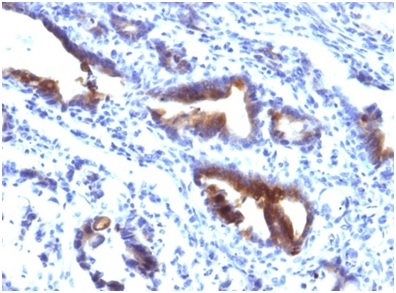 Formalin-fixed, paraffin-embedded human gastric carcinoma stained with MUC3 Mouse Monoclonal Antibody (M3.1). HIER: Tris/EDTA, pH9.0, 45min. 2 °: HRP-polymer, 30min. DAB, 5min.