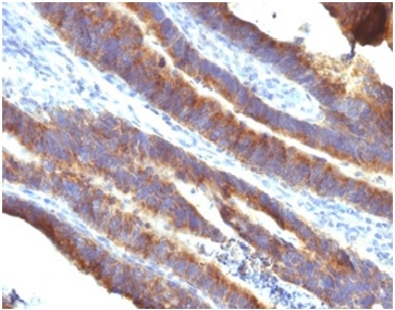 Formalin-fixed, paraffin-embedded human gastric carcinoma stained with MUC3 Mouse Monoclonal Antibody (M3.1). HIER: Tris/EDTA, pH9.0, 45min. 2°C: HRP-polymer, 30min. DAB, 5min.