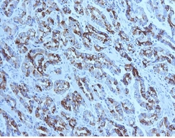 Formalin-fixed, paraffin-embedded human gastric carcinoma stained with MUC6 Mouse Monoclonal Antibody (CLH5). Courtesy of Dr. Leonor David, IPATIMUP and Medical Faculty, University of Porto, Portugal.
