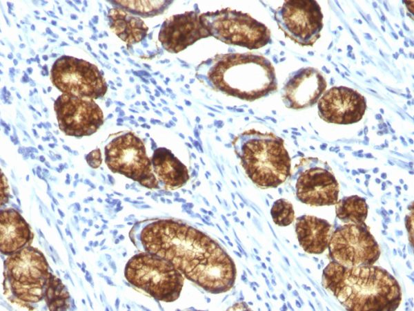 Formalin-fixed, paraffin-embedded human Gastric Carcinoma stained with MUC6 Monoclonal Antibody (MUC6/916).