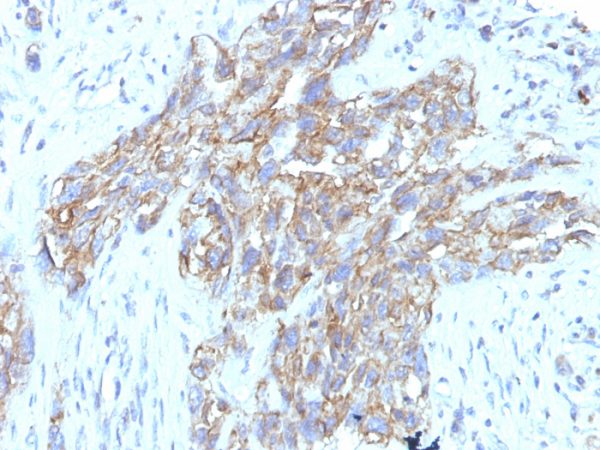 Formalin-fixed, paraffin-embedded human Lung Carcinoma stained with CD56 Monoclonal Antibody (123C3.D5 + 123A8)