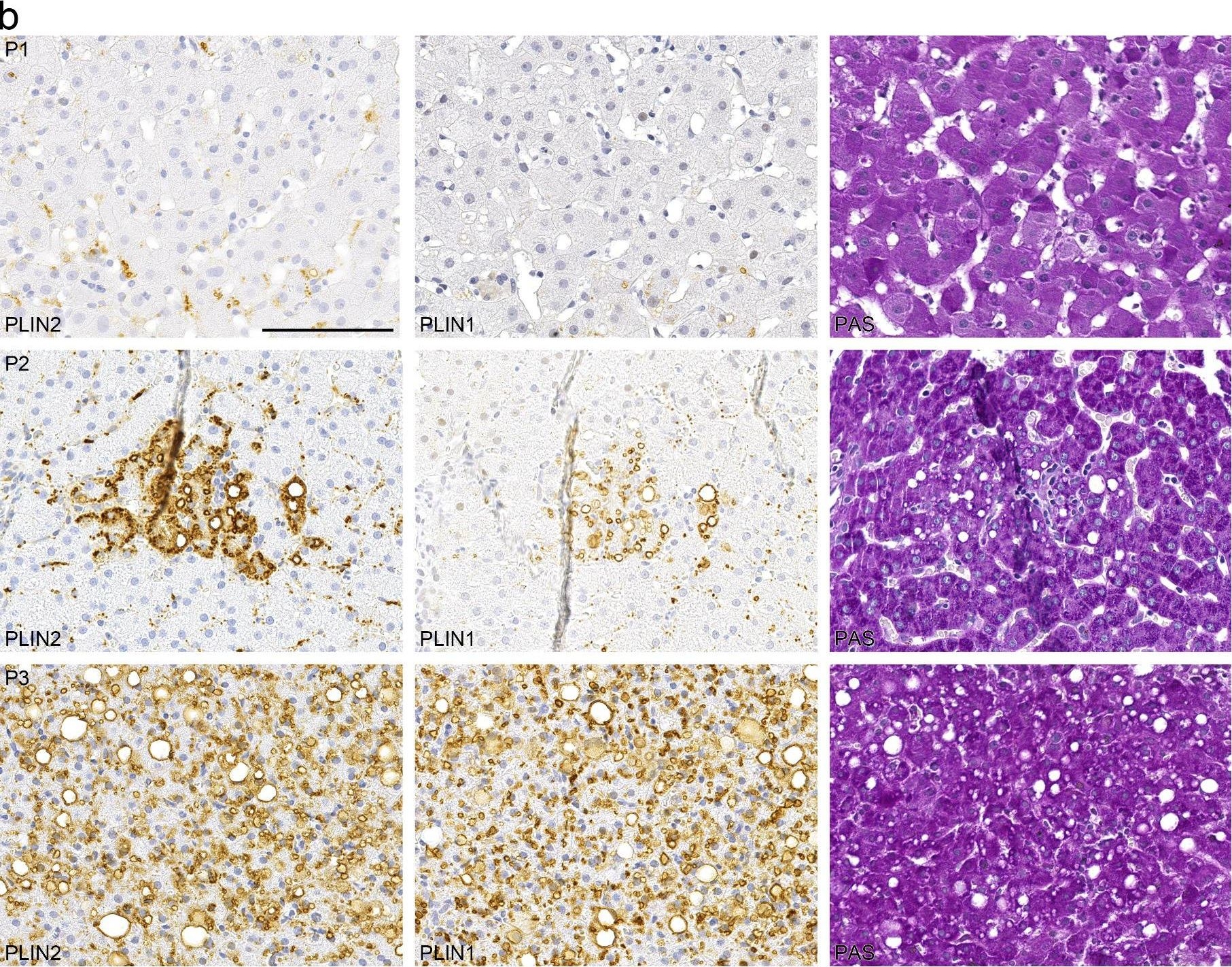 Lipid Droplet-Associated Proteins Perilipin 1 and 2: Molecular Markers of Steatosis and Microvesicular Steatotic Foci in Chronic Hepatitis C.