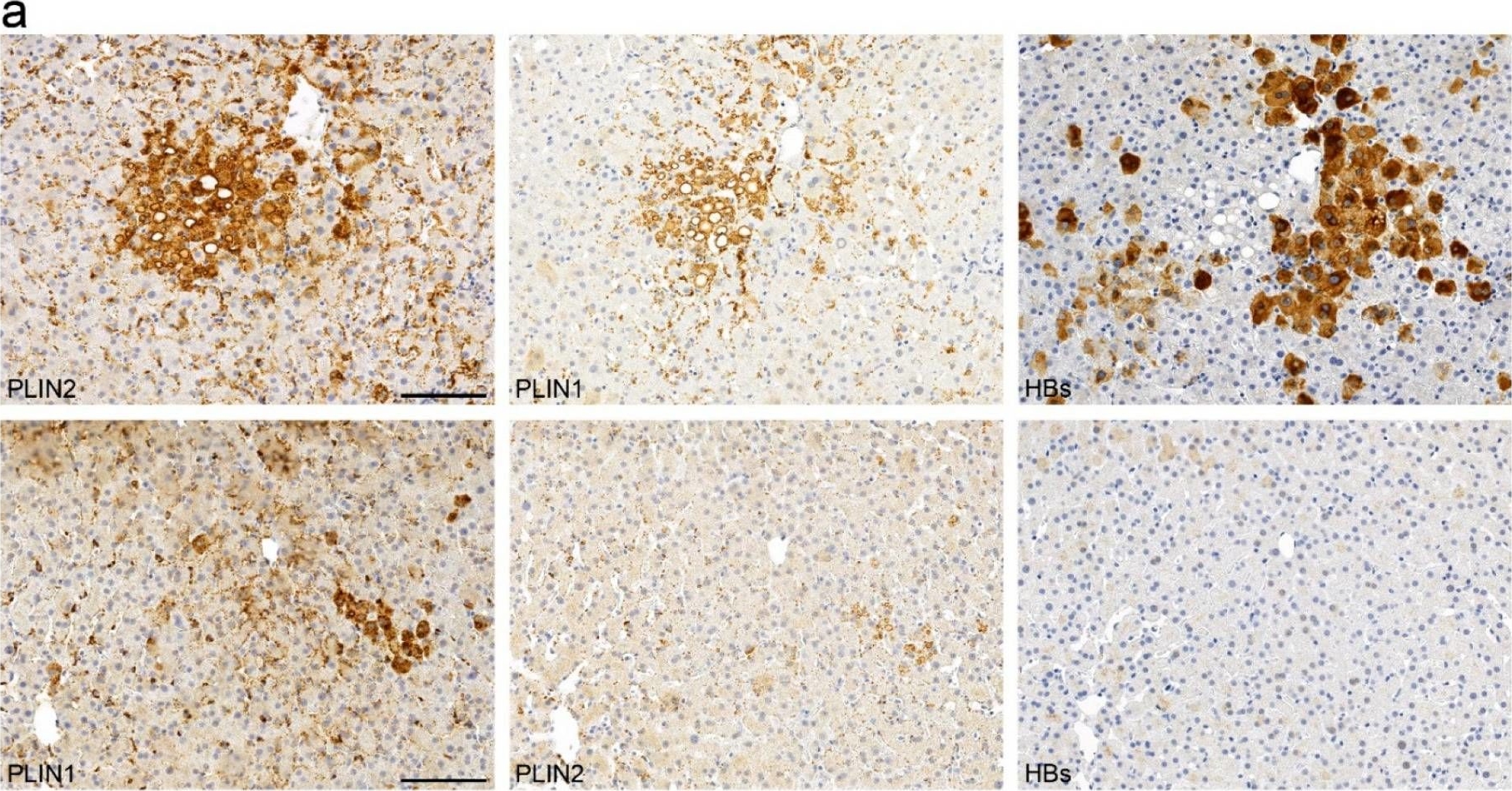 Lipid Droplet-Associated Proteins Perilipin 1 and 2: Molecular Markers of Steatosis and Microvesicular Steatotic Foci in Chronic Hepatitis C.