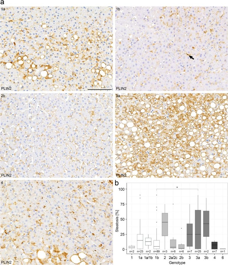 Lipid Droplet-Associated Proteins Perilipin 1 and 2: Molecular Markers of Steatosis and Microvesicular Steatotic Foci in Chronic Hepatitis C.