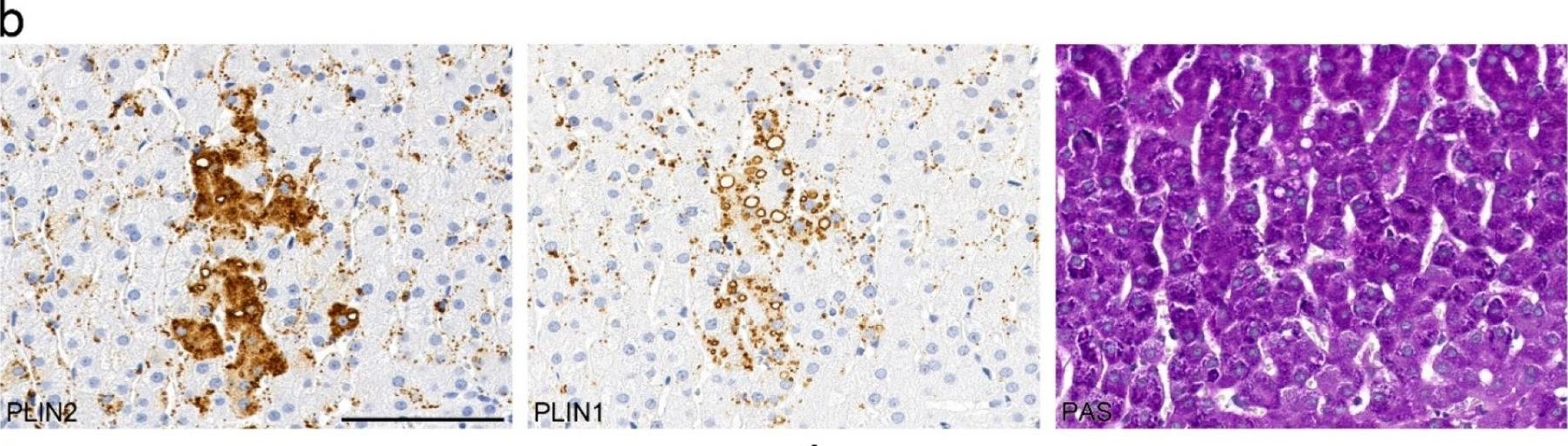 Lipid Droplet-Associated Proteins Perilipin 1 and 2: Molecular Markers of Steatosis and Microvesicular Steatotic Foci in Chronic Hepatitis C.