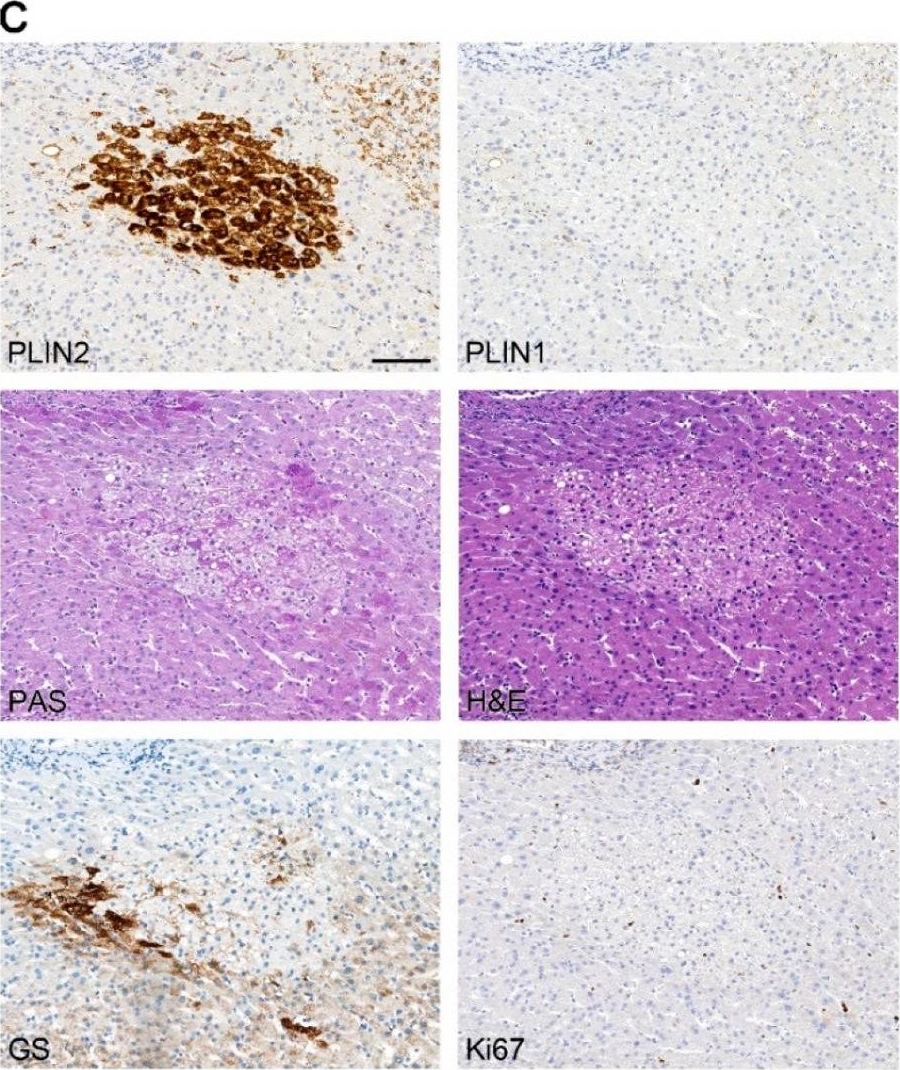 Lipid Droplet-Associated Proteins Perilipin 1 and 2: Molecular Markers of Steatosis and Microvesicular Steatotic Foci in Chronic Hepatitis C.