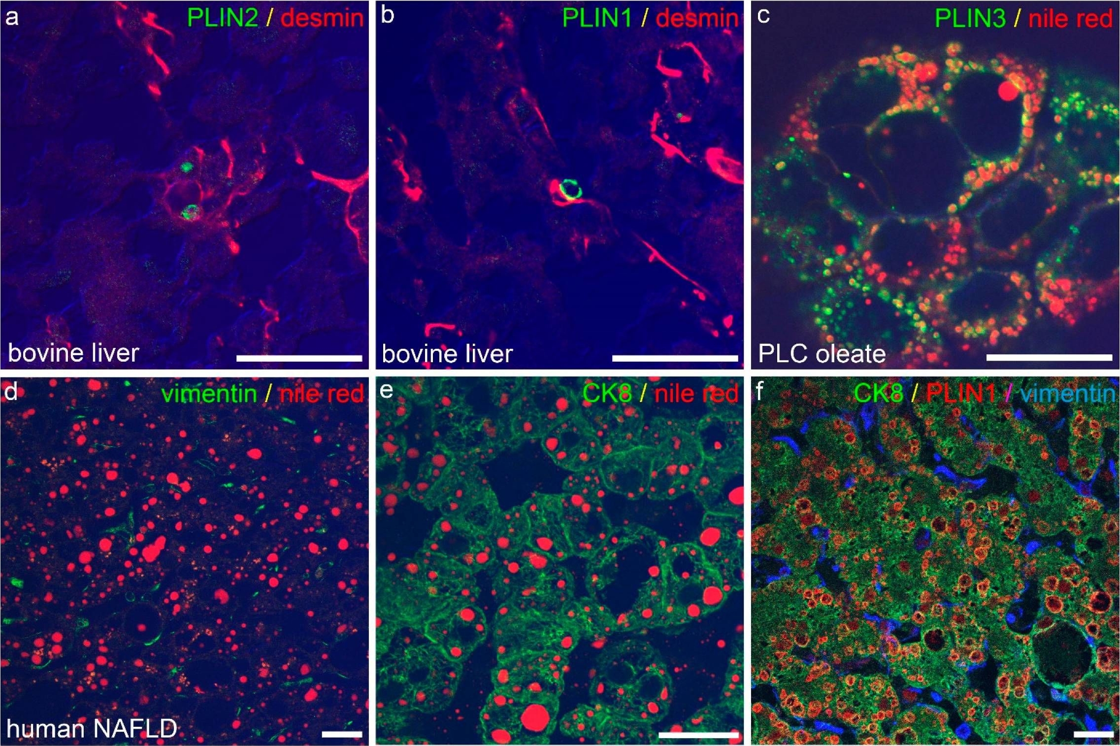 Lipid Droplet-Associated Proteins Perilipin 1 and 2: Molecular Markers of Steatosis and Microvesicular Steatotic Foci in Chronic Hepatitis C.