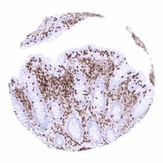 In the appendix, CD45 immunostaining is stronger in lymphocytes than in macrophages. Epithelial cells are completely CD45 negative