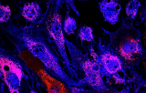 EGR1 probe for FISH CE/IVD - Acute myeloid leukemia (AML)