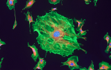 Sonde PDGFRB pour l'HIS CE/IVD - Leucémie myéloïde aiguë (AML)